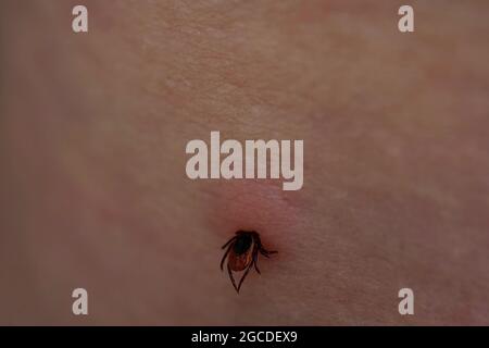 Gros plan de la tique sucer femelle sur la peau irritée humaine. Ixodes ricinus ballonnés parasite dangereux piquant dans l'épiderme rose irrité. Danger d'env Banque D'Images