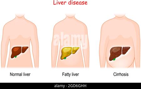 Maladies du foie. Stades de lésions hépatiques. Sain, gras, et cirrhose. Corps humain avec des organes internes éclairés sains et malades. Vecteur Illustration de Vecteur