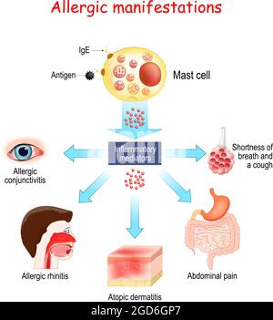 Allergie alimentaire et manifestations allergiques. Cellules de mât et médiateurs inflammatoires. Conjonctivite allergique, dermatite atopique, rhinite allergique. Vecteur Illustration de Vecteur