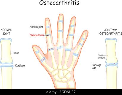 arthrose. Os d'une main humaine. Gros plan du cartilage normal de l'articulation et de l'articulation avec une maladie dégénérative Illustration de Vecteur