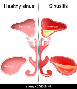 Sinusite. Sinus nasal et sinus sains avec infection (inflammation et liquide). Illustration vectorielle Illustration de Vecteur