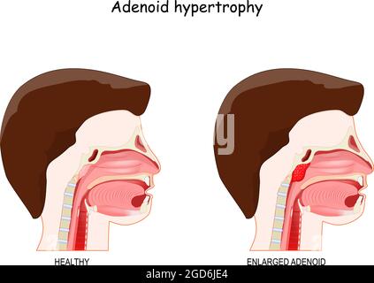 Hypertrophie des adénoïdes. Coupe transversale de la tête humaine avec des adénoïdes sains et inflammatoires. Illustration vectorielle Illustration de Vecteur