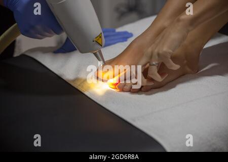 traitement au laser des champignons des ongles à la clinique Banque D'Images