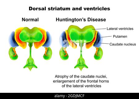 Striatum dorsal et ventricules dans la maladie de Huntington Banque D'Images