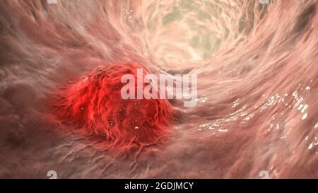 Carcinome intestinal, illustration Banque D'Images