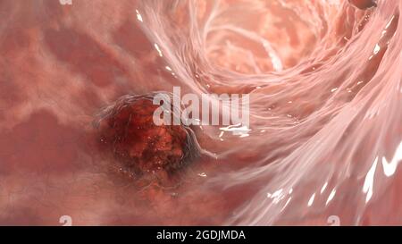 Carcinome intestinal, illustration Banque D'Images