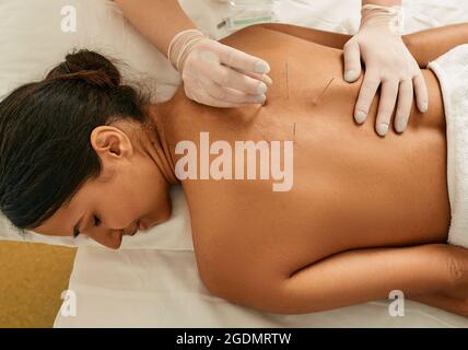 Acupuncture pour le dos d'une jeune femme dans une clinique chinoise. Vue de dessus Banque D'Images