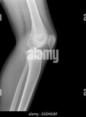 homme de 13 ans avec contusion sur le genou gauche. Vue latérale sans fracture Banque D'Images