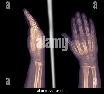 radiographie du poignet et de la main d'une patiente de 2 ans montrant 2 et 3 fractures métacarpiennes Banque D'Images