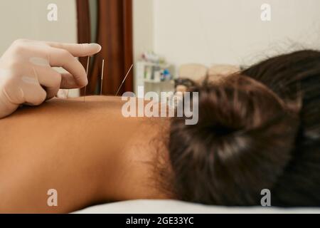 Réflexologie. Traitement des douleurs dorsales et de l'oppression avec des aiguilles d'acupuncture pour une patiente Banque D'Images