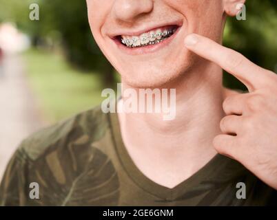 Gros plan, court cliché du sourire de l'homme portant des bretelles dentaires, posant à l'extérieur, pointant vers sa bouche. Image horizontale. Photographie macro. Concept d'hygiène et de soins buccaux Banque D'Images