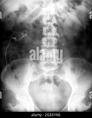 Radiographie d'un abdomen d'une patiente de 50 ans Banque D'Images