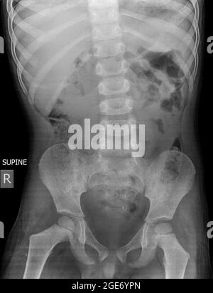 Radiographie abdominale d'un enfant de 5 ans allongé (position Décubitus dorsal) Banque D'Images