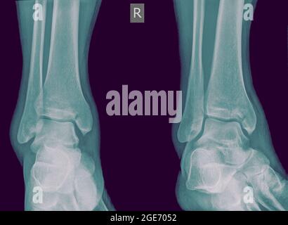 Radiographie d'un homme de 50 ans à la cheville présentant un tibia fracturé. Vue avant Banque D'Images