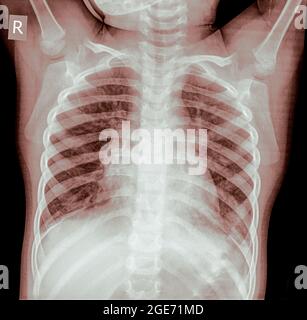 Radiographie thoracique d'un nourrisson de 3 ans. Vue avant Banque D'Images