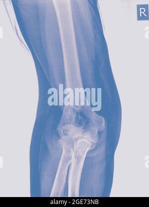 X ray d'une fracture de l'humérus (coude) d'une patiente âgée de 70 ans vue avant Banque D'Images