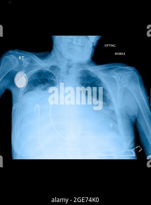 Radiographie thoracique d'une patiente de 71 ans souffrant de dyspnée Banque D'Images