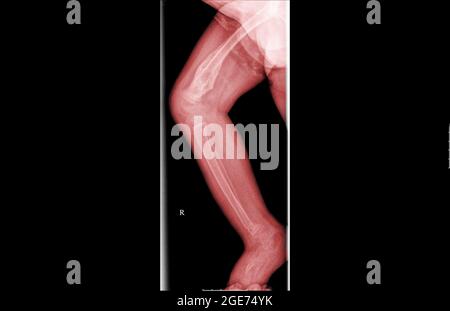 Radiographie d'un enfant de 3 ans avec un talon fracture du tibia et du péroné Banque D'Images