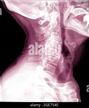 Vue latérale d'une patiente de 72 ans avec radiographie du rachis cervical Banque D'Images