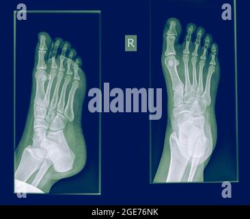 Radiographie d'un pied montrant une fracture de la phalange proximale du gros orteil sur le pied d'une patiente âgée de 30 ans Banque D'Images