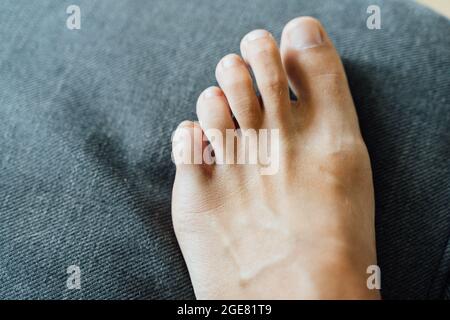 Blessure au pied, au petit doigt. Peu de douleurs aux orteils et des ecchymoses après un accident à la maison. Fracture de Phalange. Ongles pieds nus en bonne santé. Banque D'Images