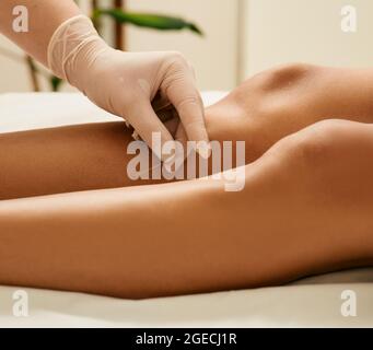 Traitement par acupuncture des douleurs chroniques aux jambes. Chiropraticien faisant acupuncture thérapie pour la femelle shin avec des aiguilles Banque D'Images