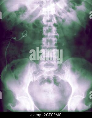 Radiographie d'un abdomen d'une patiente de 50 ans Banque D'Images