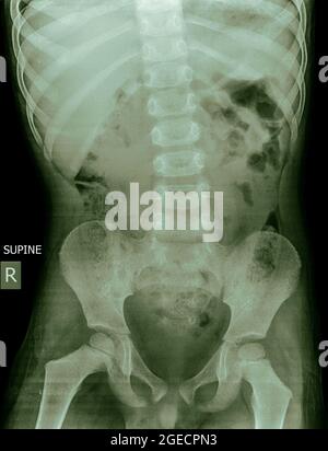 Radiographie abdominale d'un enfant de 5 ans allongé (position Décubitus dorsal) Banque D'Images