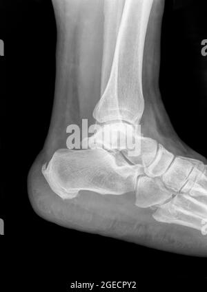 Radiographie d'un mâle de 50 ans de la cheville présentant un tibia distal fracturé. Vue latérale Banque D'Images