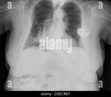 radiographie thoracique d'une patiente de 82 ans équipée d'un appareil de stimulation Banque D'Images