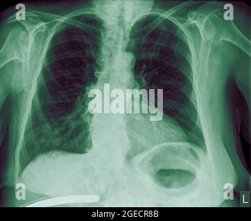Radiographie thoracique d'une patiente de 57 ans présentant des signes de pneumonie dans le lobe inférieur droit (RLL) de son poumon vue avant Banque D'Images