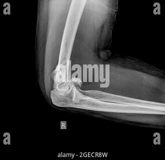 Vue latérale d'une patiente de 70 ans présentant un coude fracturé (os d'humérus) Banque D'Images