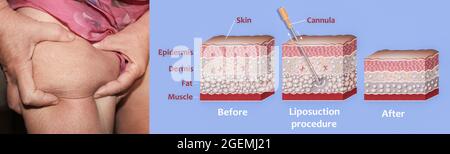 Mécanisme de liposuccion. Liposuccion assistée par aspiration. Tube creux ou canule, qui est inséré à travers une petite incision dans la peau afin de la graisse aspirée hors du corps Banque D'Images