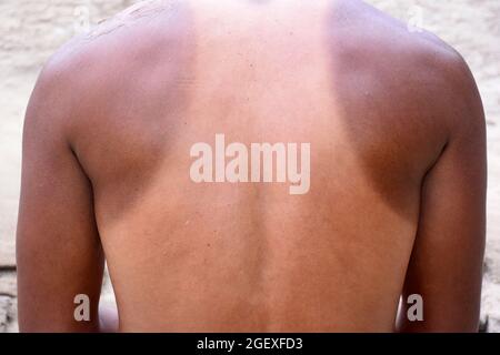 Épaules et peau de cou brûlée au soleil, partie du corps entre l'articulation supérieure latérale du bras humain et le cou, réaction à une blessure ou infection Banque D'Images