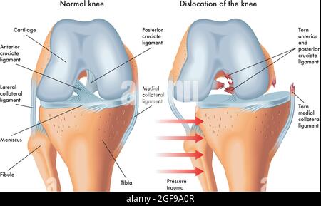 Illustration médicale des symptômes du genou dislogée, avec annotations. Illustration de Vecteur