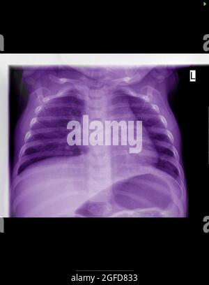 Radiographie d'un nourrisson de 6 mois souffrant de gastro-entérite virale et de leucopénie Banque D'Images