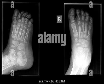 Fracture dans le premier os métatarsien du pied droit d'un homme âgé de 3 ans Banque D'Images