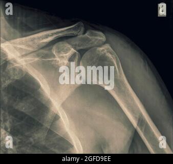 X-ray de l'épaule d'un homme de 40 ans avec une fracture de la clavicule vue avant Banque D'Images