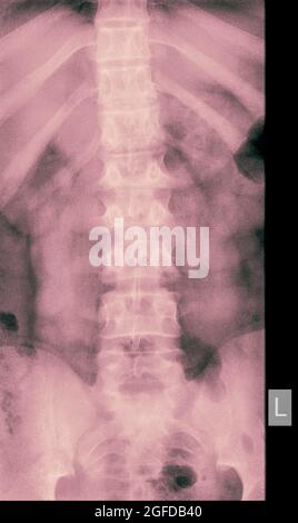 Radiographie du rachis lombaire humain d'un homme de 14 ans présentant une fracture de compression de la vertèbre L2 vue avant Banque D'Images