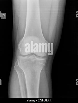 Genou radiographie d'un patient de sexe masculin de 44 ans vue avant Banque D'Images