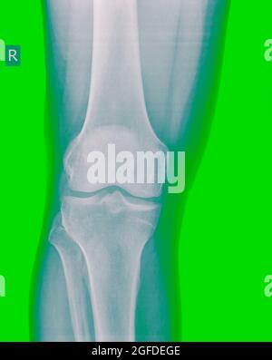 Genou radiographie d'un patient de sexe masculin de 44 ans vue avant Banque D'Images