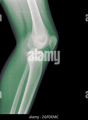 homme de 13 ans avec contusion sur le genou gauche. Vue latérale sans fracture Banque D'Images
