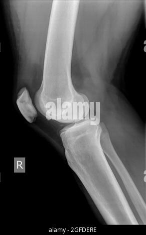 Genou avec rotule fracturée. Radiographie d'un homme de 27 ans vue latérale du patient Banque D'Images