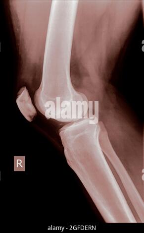 Genou avec rotule fracturée. Radiographie d'un homme de 27 ans vue latérale du patient Banque D'Images