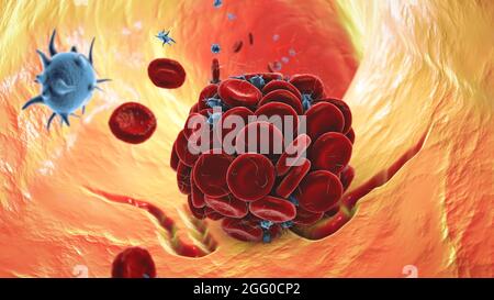 Illustration d'un caillot de sang dans un vaisseau sanguin endommagé composé de globules rouges, de plaquettes et de brins de protéine de fibrine. Banque D'Images