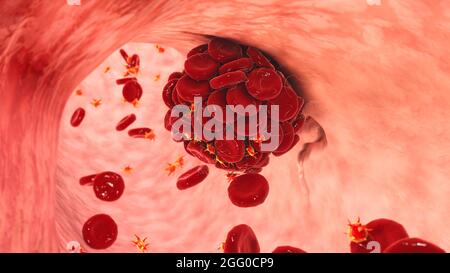 Illustration d'un caillot de sang dans un vaisseau sanguin endommagé composé de globules rouges, de plaquettes et de brins de protéine de fibrine. Banque D'Images