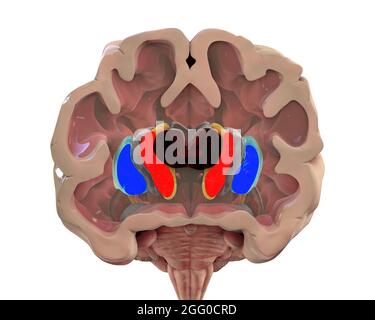 Illustration du striatum dorsal et des ventricules latéraux dans la maladie de Huntington. On observe un élargissement des cornes antérieures des ventricules latéraux (rouge foncé) et une atrophie des noyaux caudé (rouge). Banque D'Images