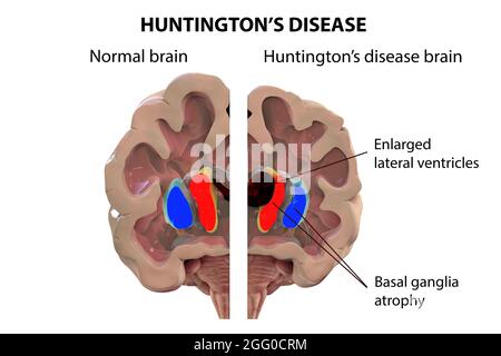 Illustration du striatum dorsal et des ventricules latéraux dans le cerveau en bonne santé et dans la maladie de Huntington (HD), montrant l'agrandissement des cornes antérieures des ventricules latéraux et l'atrophie des noyaux caudates en HD. Banque D'Images