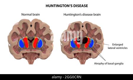 Illustration du striatum dorsal et des ventricules latéraux dans le cerveau en bonne santé et dans la maladie de Huntington (HD), montrant l'agrandissement des cornes antérieures des ventricules latéraux et l'atrophie des noyaux caudates en HD. Banque D'Images