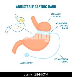 Chirurgie bariatrique à bande gastrique réglable, illustration. Banque D'Images